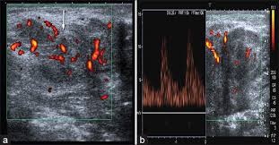 USG Soft Tissue Colour Doppler In DLF Phase IV USG Soft Tissue Colour Doppler In DLF Phase IV